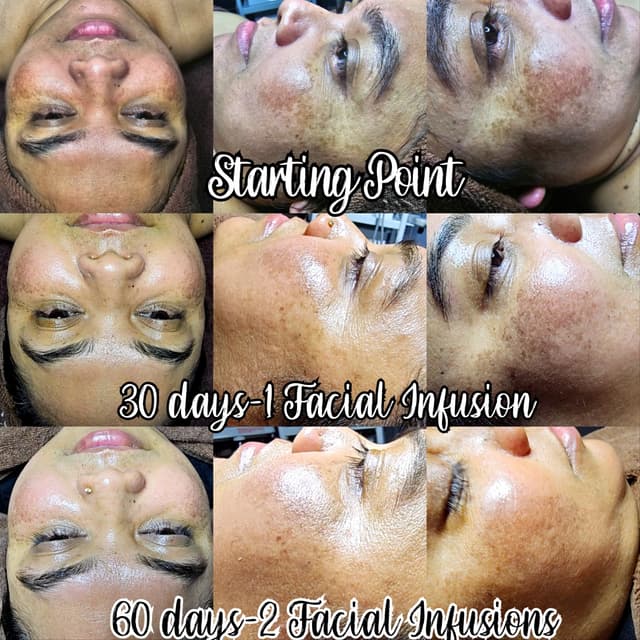 Facial Infusion 3 series at Skin & Lash Syndicate in Worcester, MA